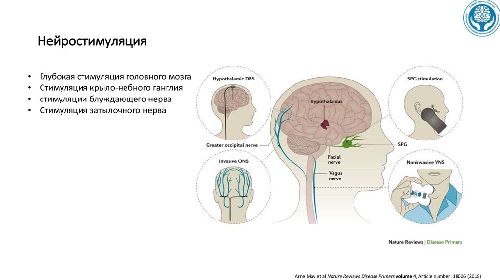 Нейропорт купить. Глубокая стимуляция мозга. Прибор для нейростимуляции мозга. Тригеминальные вегетативные цефалгии. Нейромодуляция головного мозга.