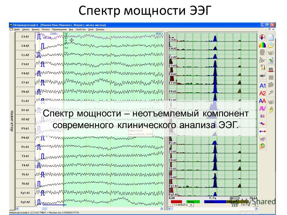 Сколько длится диагностика. Вертексные потенциалы на ЭЭГ. Спектры мощности ЭЭГ. ЭЭГ сигнал. Анализ электроэнцефалограммы.